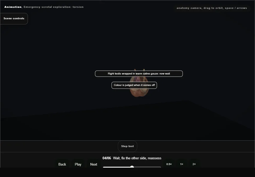 Emergency scrotal exploration: torsion. Step 4: Wait, fix the other side, reassess. Captured frame from the interactive animation.