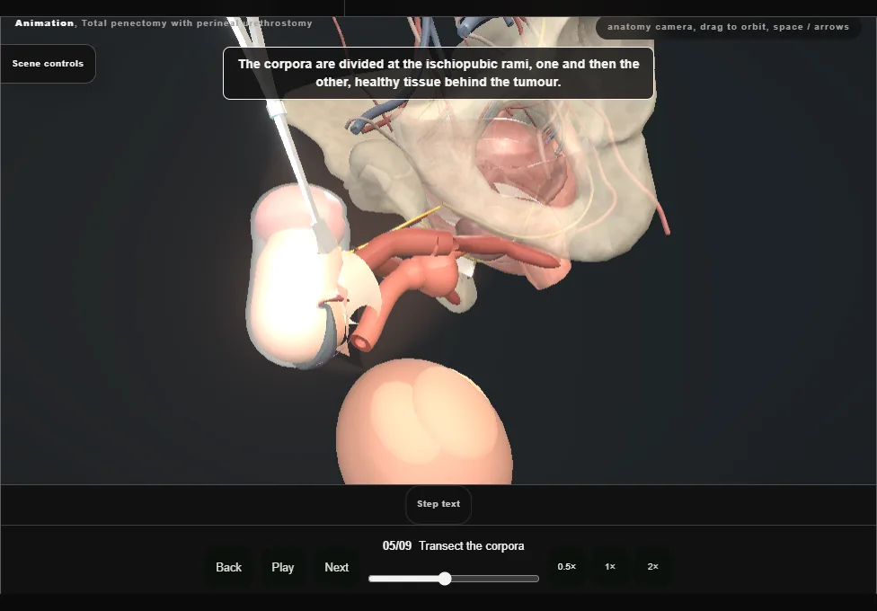 Total penectomy with perineal urethrostomy. Step 5: Transect the corpora. Captured frame from the interactive animation.