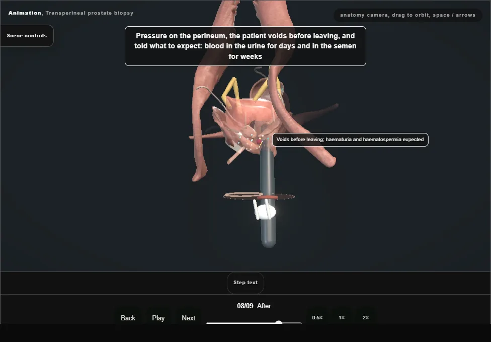 Transperineal prostate biopsy. Step 8: After. Captured frame from the interactive animation.