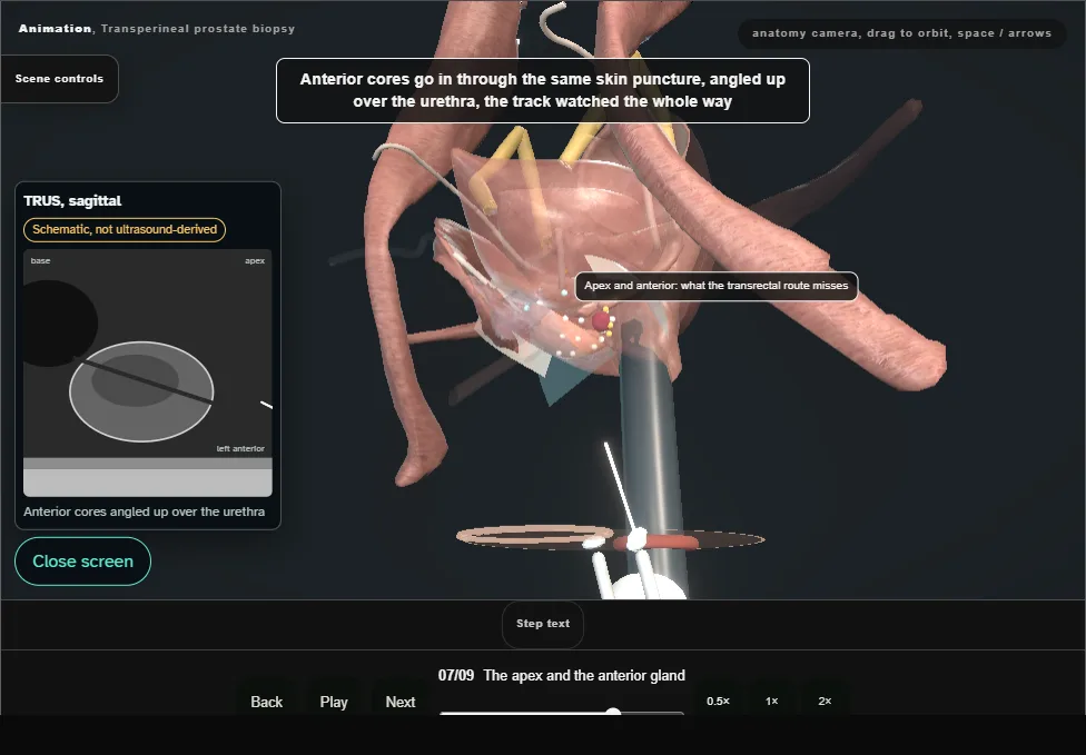 Transperineal prostate biopsy. Step 7: The apex and the anterior gland. Captured frame from the interactive animation.