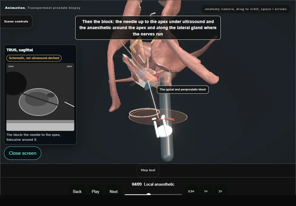 Transperineal prostate biopsy. Step 4: Local anaesthetic. Captured frame from the interactive animation.