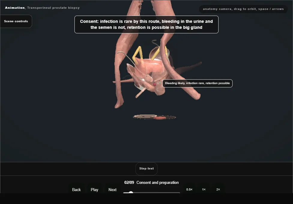 Transperineal prostate biopsy. Step 2: Consent and preparation. Captured frame from the interactive animation.