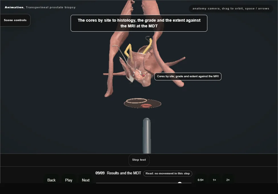 Transperineal prostate biopsy. Step 9: Results and the MDT. Captured frame from the interactive animation.