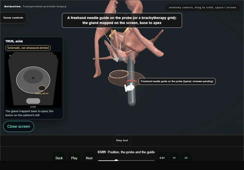 Transperineal prostate biopsy. Step 3: Position, the probe and the guide. Captured frame from the interactive animation.