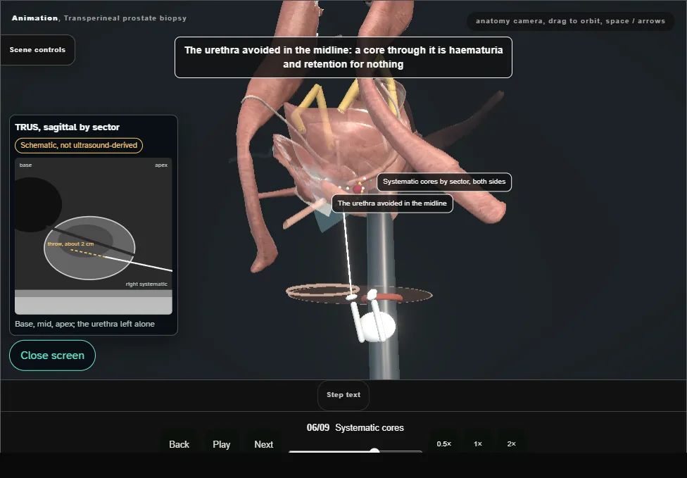 Transperineal prostate biopsy. Step 6: Systematic cores. Captured frame from the interactive animation.