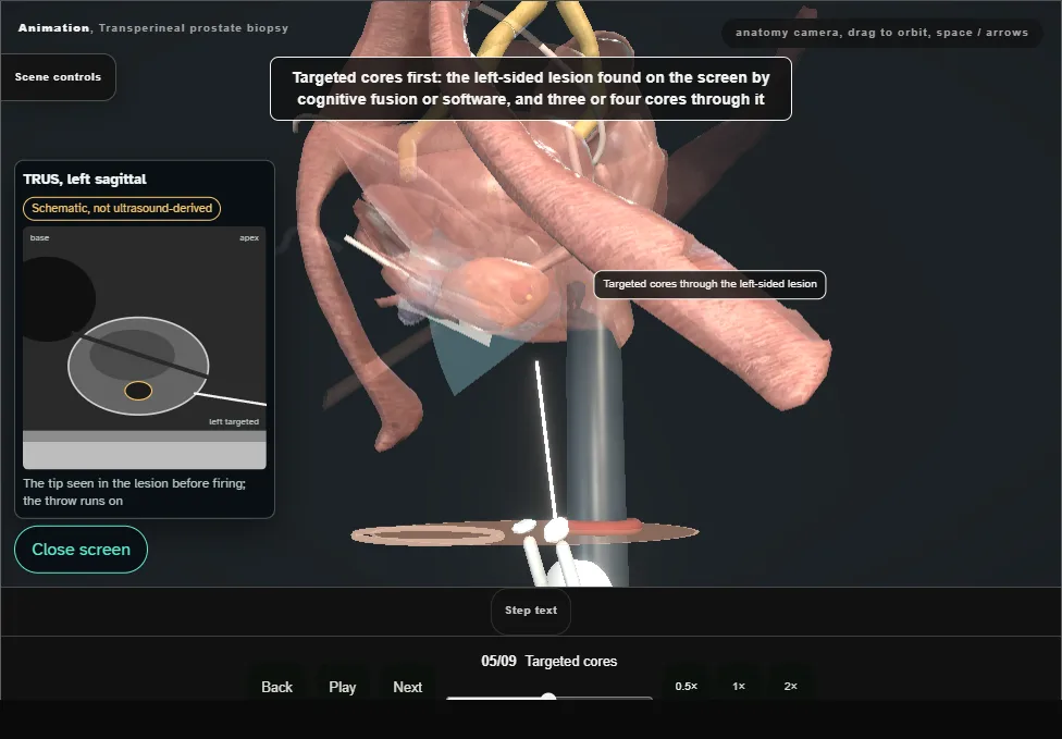 Transperineal prostate biopsy. Step 5: Targeted cores. Captured frame from the interactive animation.