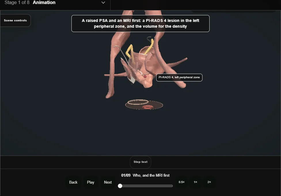 Transperineal prostate biopsy. Step 1: Who, and the MRI first. Captured frame from the interactive animation.