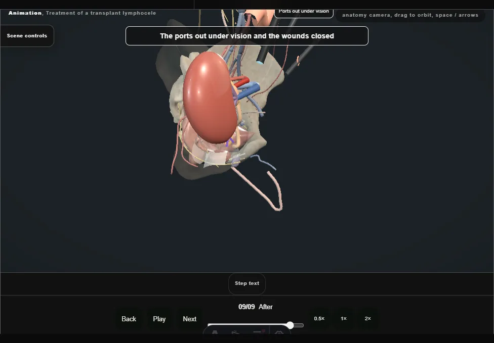 Treatment of a transplant lymphocele. Step 9: After. Captured frame from the interactive animation.