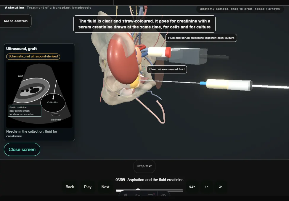 Treatment of a transplant lymphocele. Step 3: Aspiration and the fluid creatinine. Captured frame from the interactive animation.