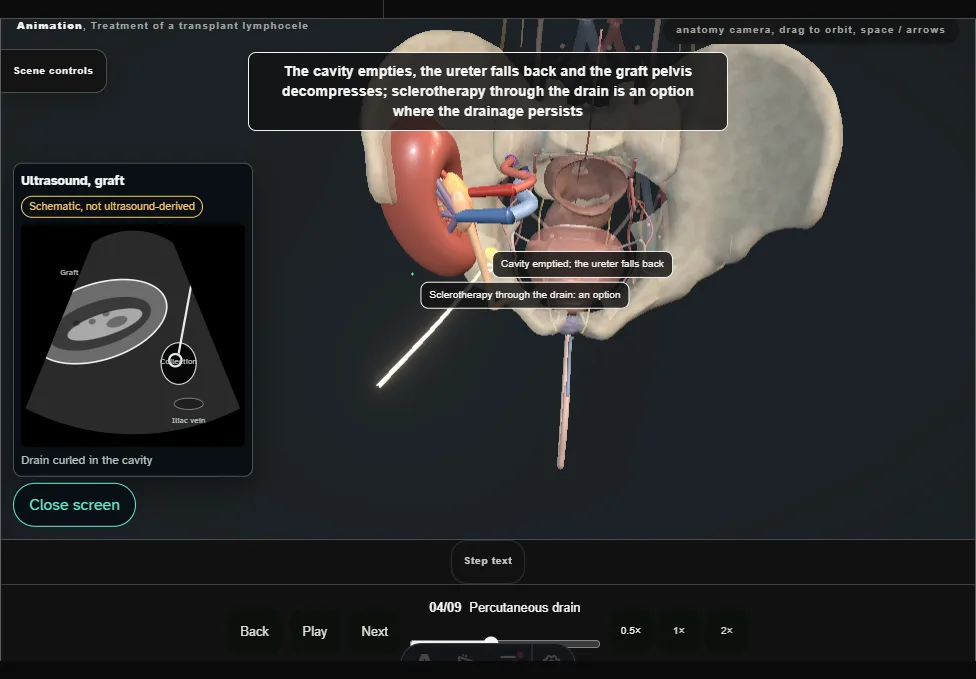 Treatment of a transplant lymphocele. Step 4: Percutaneous drain. Captured frame from the interactive animation.