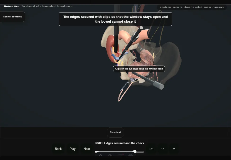 Treatment of a transplant lymphocele. Step 8: Edges secured and the check. Captured frame from the interactive animation.