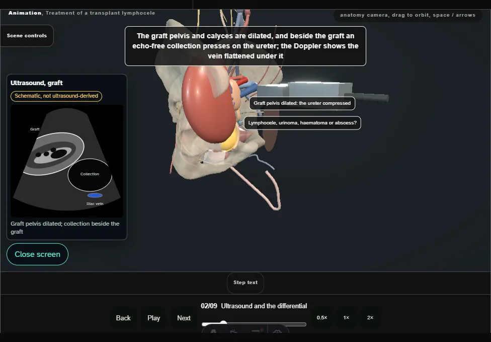 Treatment of a transplant lymphocele. Step 2: Ultrasound and the differential. Captured frame from the interactive animation.