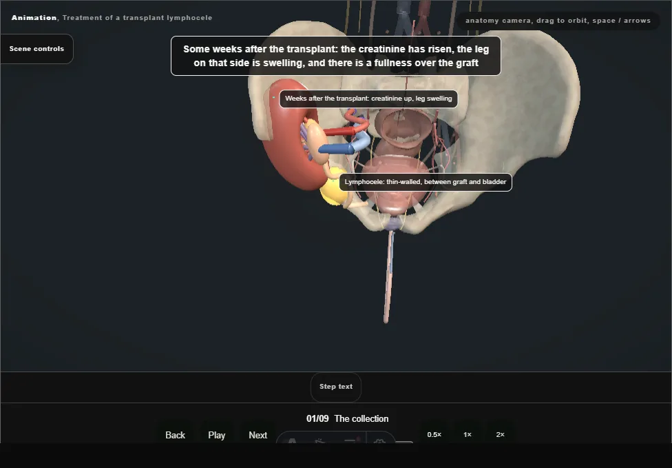 Treatment of a transplant lymphocele. Step 1: The collection. Captured frame from the interactive animation.