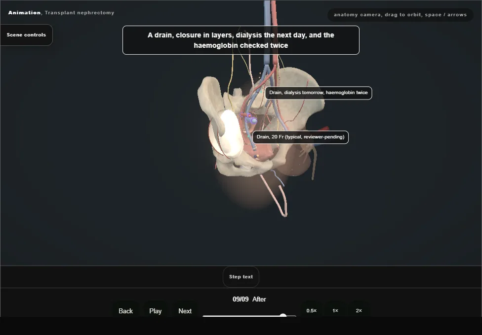 Transplant nephrectomy. Step 9: After. Captured frame from the interactive animation.
