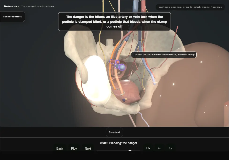 Transplant nephrectomy. Step 8: Bleeding: the danger. Captured frame from the interactive animation.