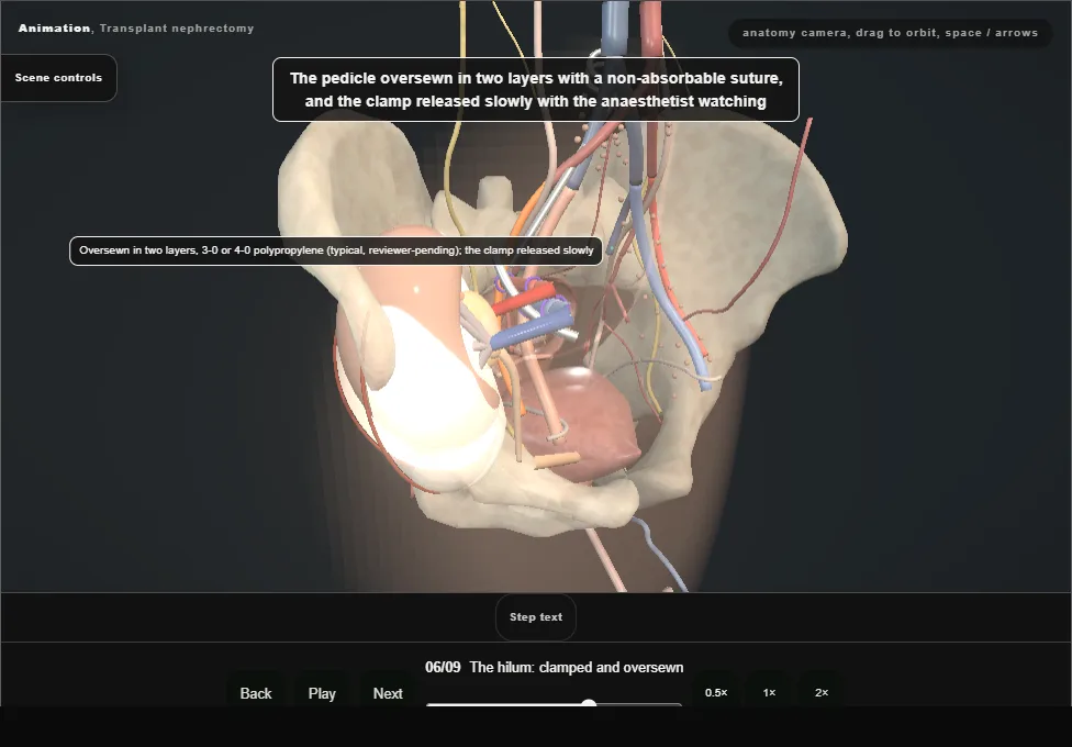 Transplant nephrectomy. Step 6: The hilum: clamped and oversewn. Captured frame from the interactive animation.