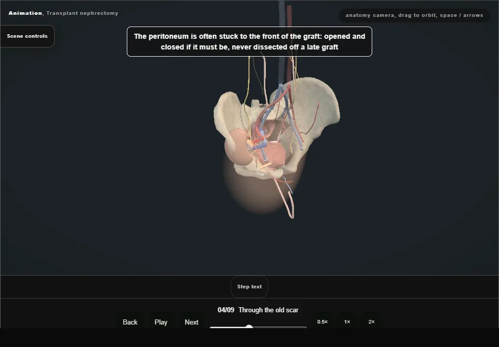 Transplant nephrectomy. Step 4: Through the old scar. Captured frame from the interactive animation.