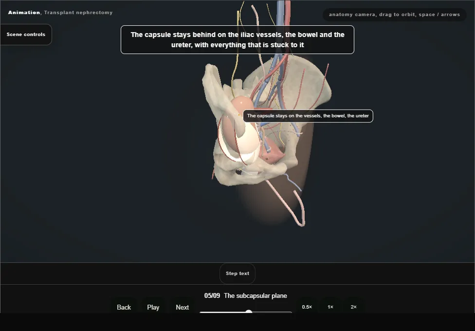 Transplant nephrectomy. Step 5: The subcapsular plane. Captured frame from the interactive animation.