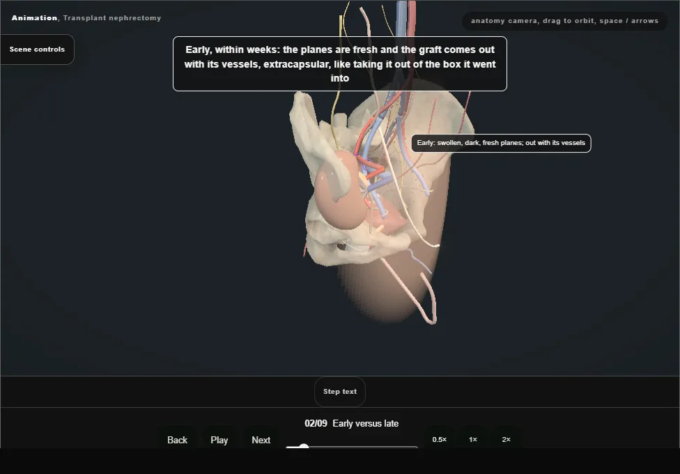 Transplant nephrectomy. Step 2: Early versus late. Captured frame from the interactive animation.