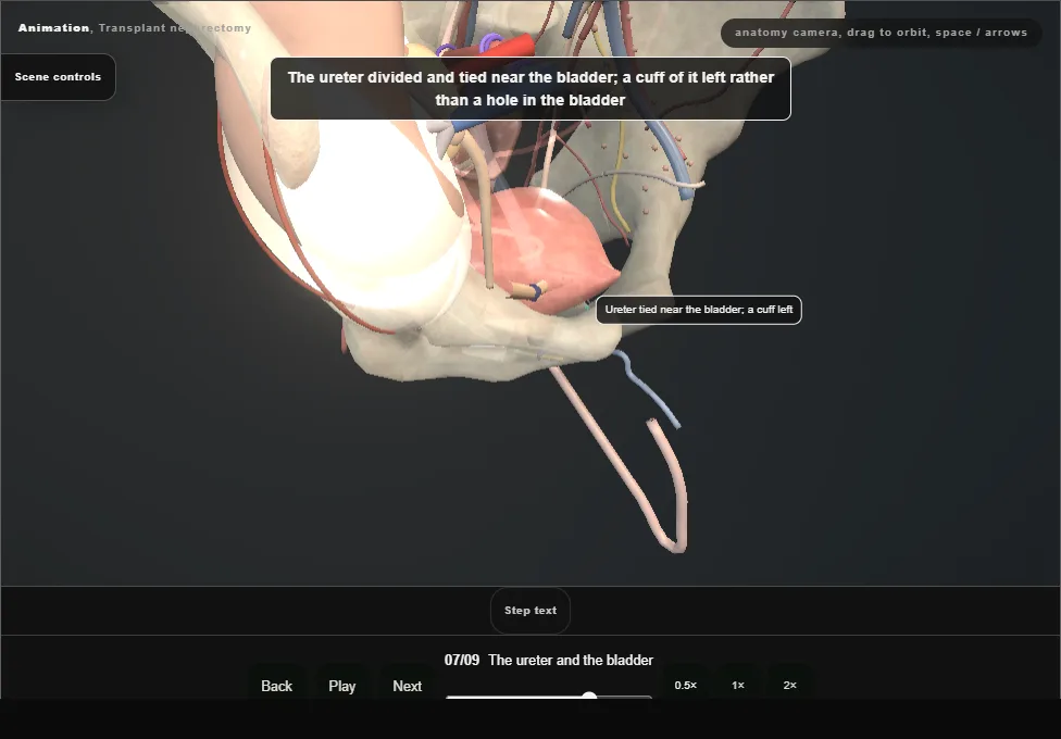 Transplant nephrectomy. Step 7: The ureter and the bladder. Captured frame from the interactive animation.