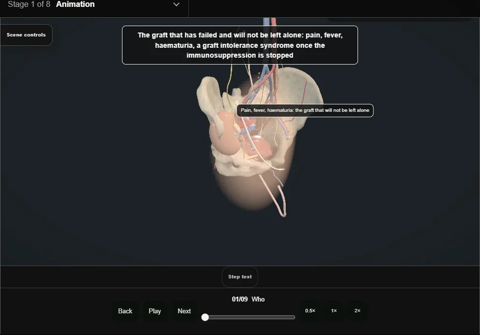 Transplant nephrectomy. Step 1: Who. Captured frame from the interactive animation.