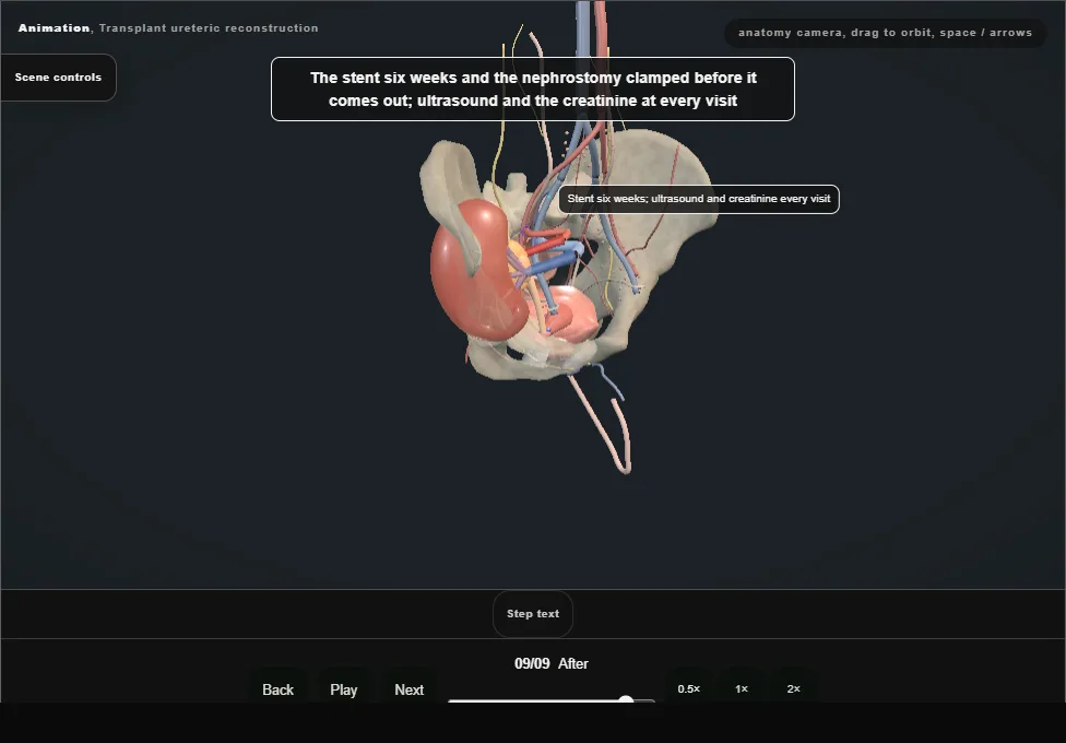 Transplant ureteric reconstruction. Step 9: After. Captured frame from the interactive animation.