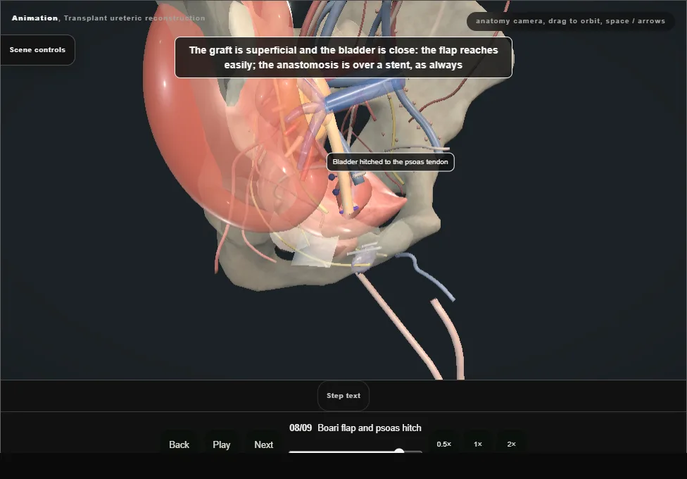 Transplant ureteric reconstruction. Step 8: Boari flap and psoas hitch. Captured frame from the interactive animation.