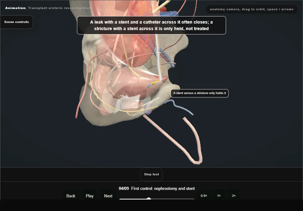 Transplant ureteric reconstruction. Step 4: First control: nephrostomy and stent. Captured frame from the interactive animation.