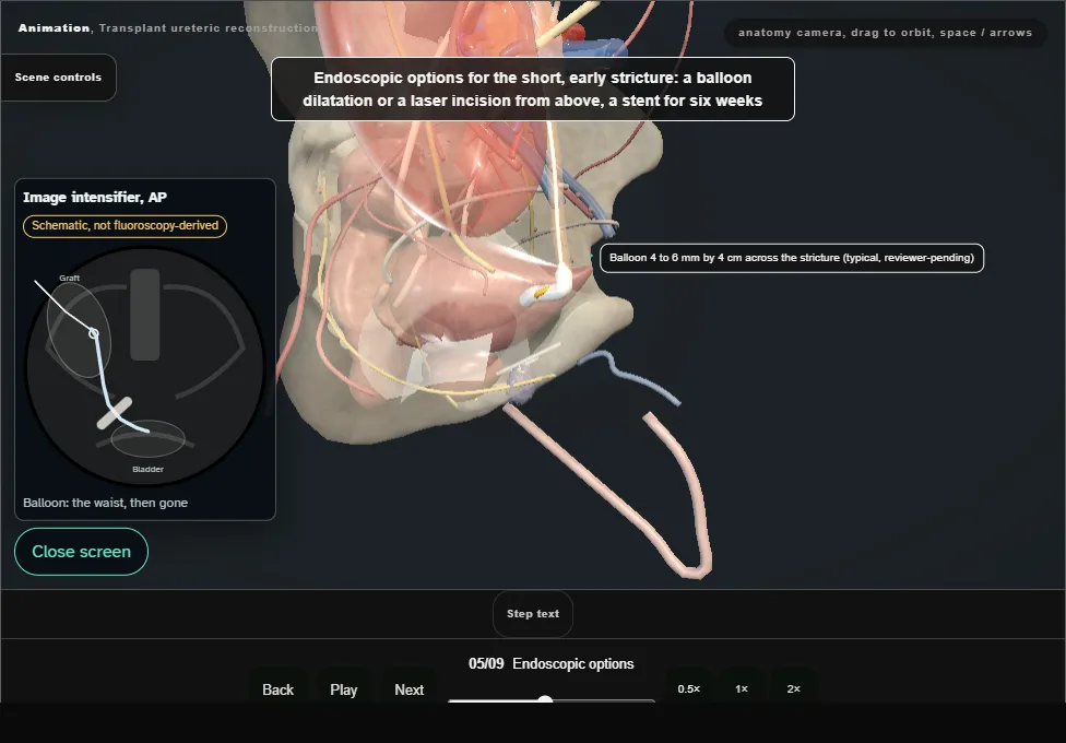 Transplant ureteric reconstruction. Step 5: Endoscopic options. Captured frame from the interactive animation.