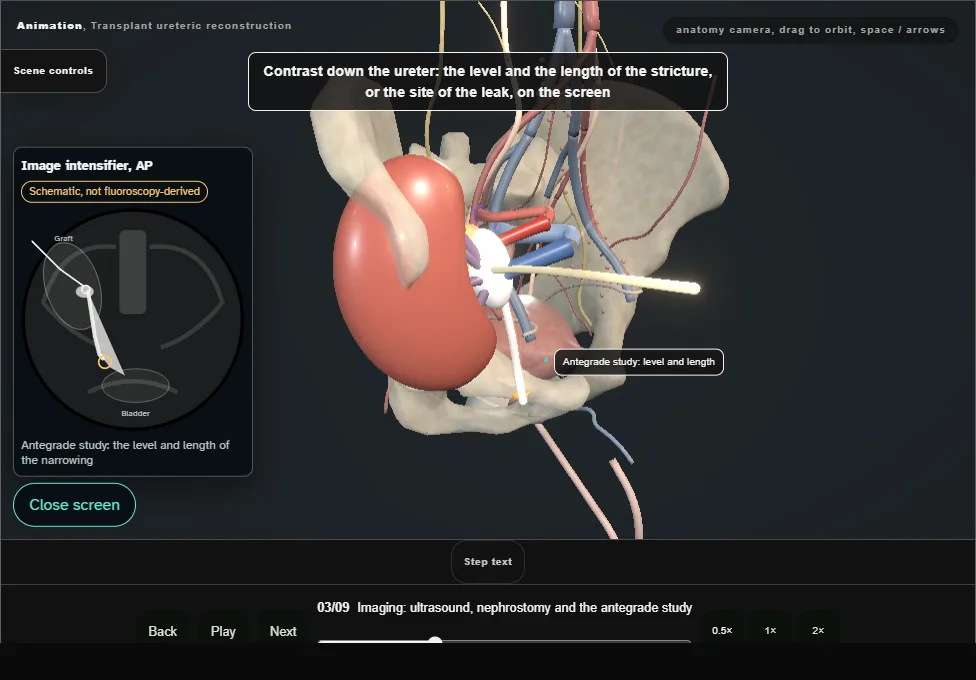 Transplant ureteric reconstruction. Step 3: Imaging: ultrasound, nephrostomy and the antegrade study. Captured frame from the interactive animation.