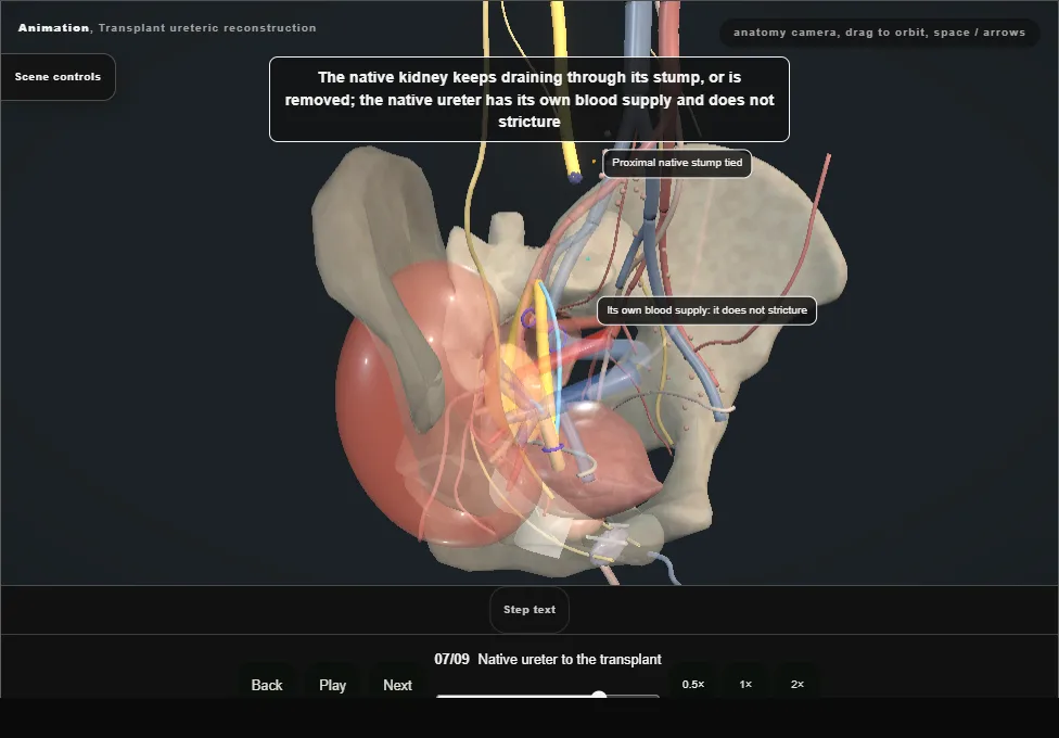 Transplant ureteric reconstruction. Step 7: Native ureter to the transplant. Captured frame from the interactive animation.