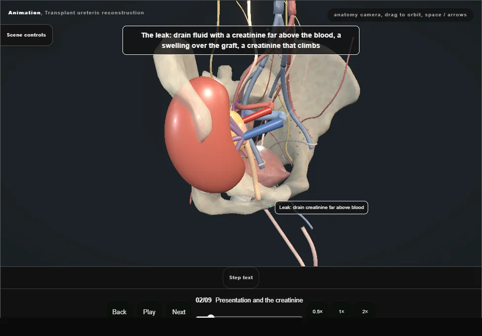 Transplant ureteric reconstruction. Step 2: Presentation and the creatinine. Captured frame from the interactive animation.