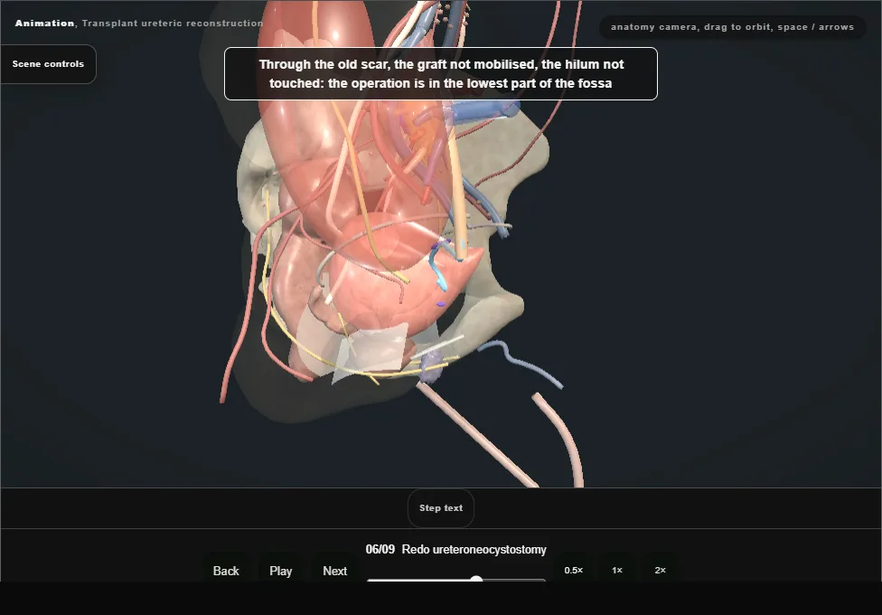 Transplant ureteric reconstruction. Step 6: Redo ureteroneocystostomy. Captured frame from the interactive animation.