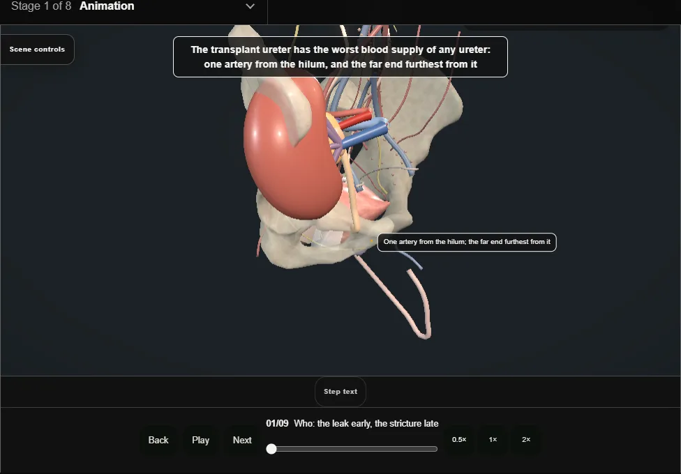 Transplant ureteric reconstruction. Step 1: Who: the leak early, the stricture late. Captured frame from the interactive animation.