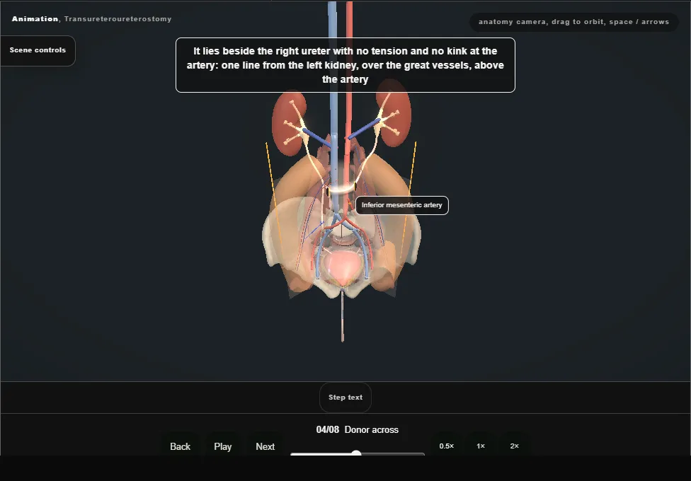 Transureteroureterostomy. Step 4: Donor across. Captured frame from the interactive animation.