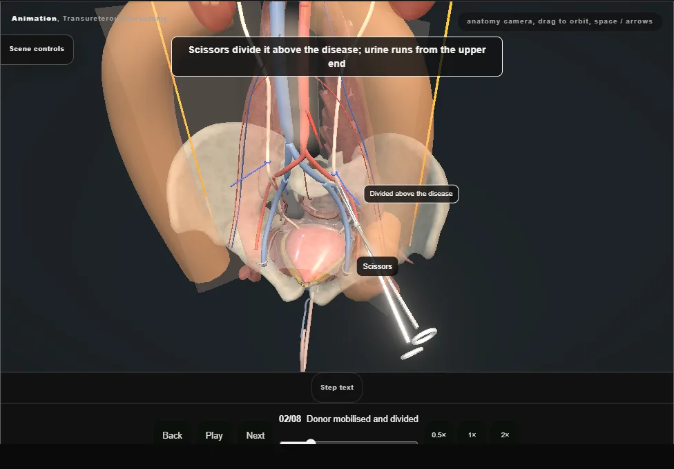 Transureteroureterostomy. Step 2: Donor mobilised and divided. Captured frame from the interactive animation.