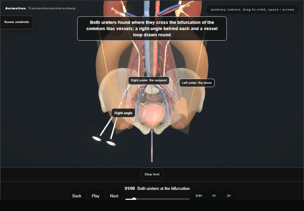 Transureteroureterostomy. Step 1: Both ureters at the bifurcation. Captured frame from the interactive animation.