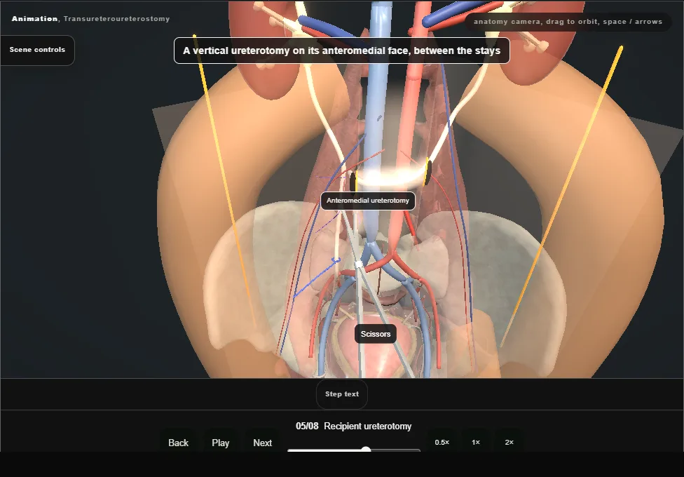 Transureteroureterostomy. Step 5: Recipient ureterotomy. Captured frame from the interactive animation.