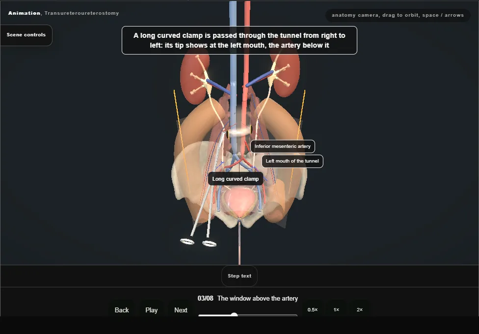 Transureteroureterostomy. Step 3: The window above the artery. Captured frame from the interactive animation.