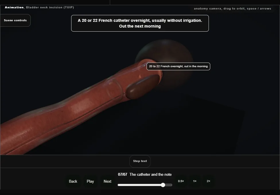 Bladder neck incision (TUIP). Step 7: The catheter and the note. Captured frame from the interactive animation.