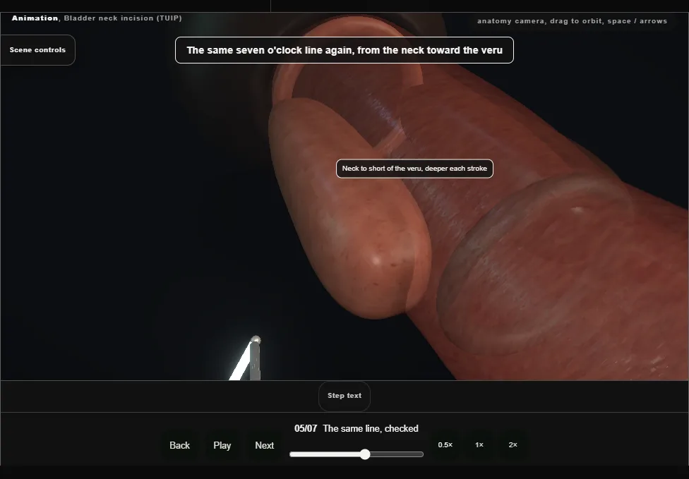 Bladder neck incision (TUIP). Step 5: The same line, checked. Captured frame from the interactive animation.