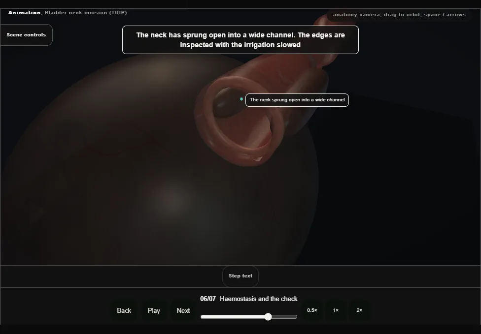 Bladder neck incision (TUIP). Step 6: Haemostasis and the check. Captured frame from the interactive animation.