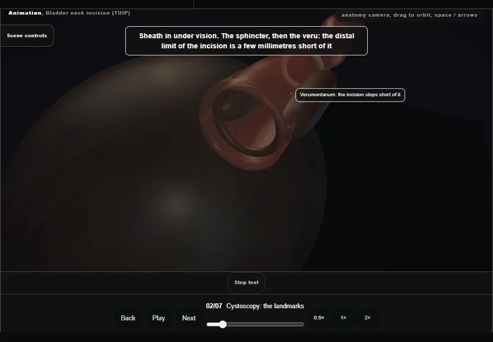 Bladder neck incision (TUIP). Step 2: Cystoscopy: the landmarks. Captured frame from the interactive animation.