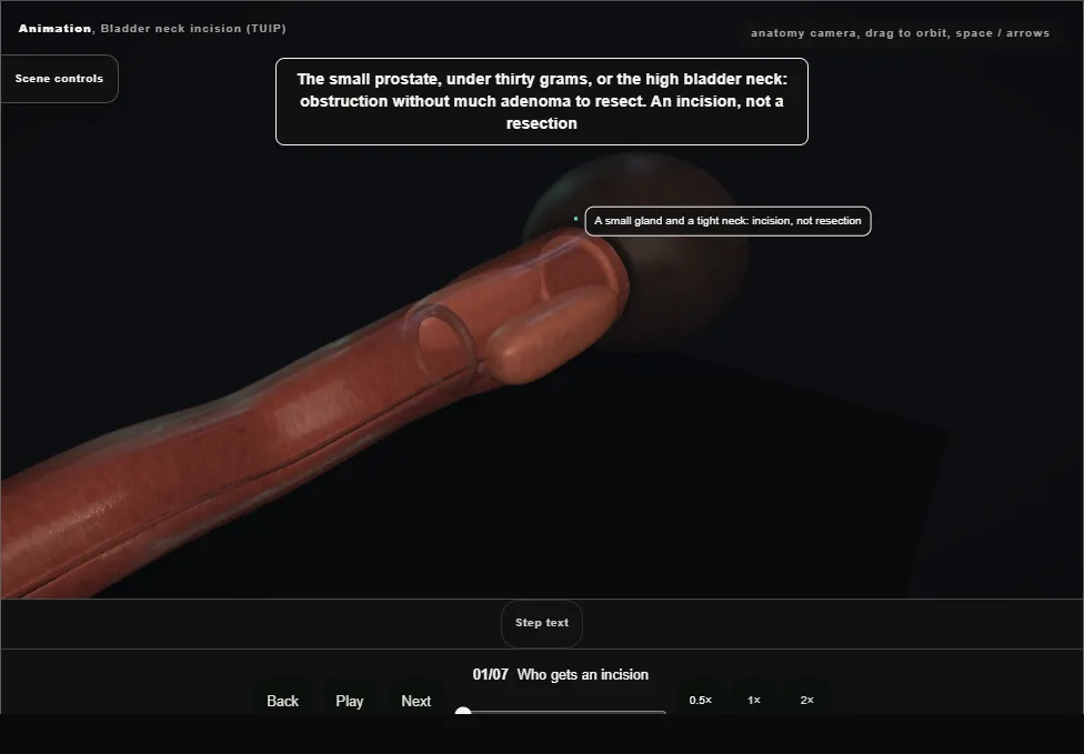 Bladder neck incision (TUIP). Step 1: Who gets an incision. Captured frame from the interactive animation.