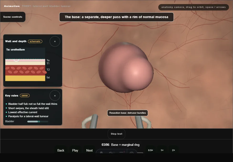 TURBT: lateral-wall bladder tumour. Step 3: Base + marginal ring. Captured frame from the interactive animation.