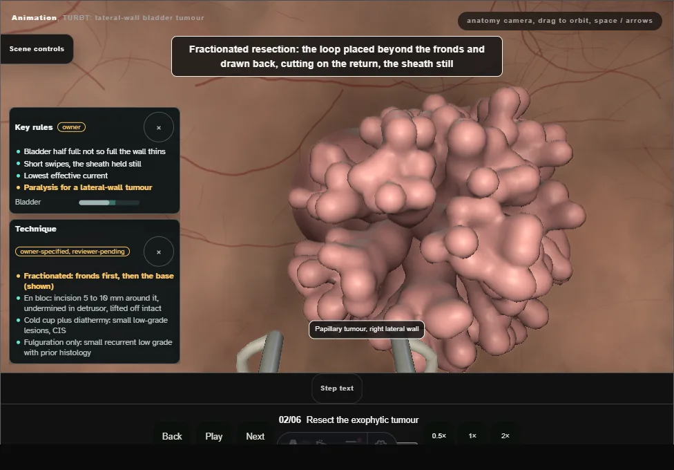 TURBT: lateral-wall bladder tumour. Step 2: Resect the exophytic tumour. Captured frame from the interactive animation.