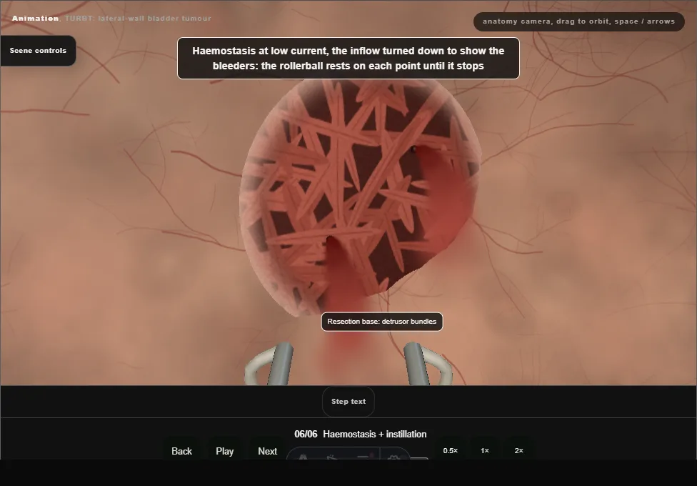 TURBT: lateral-wall bladder tumour. Step 6: Haemostasis + instillation. Captured frame from the interactive animation.