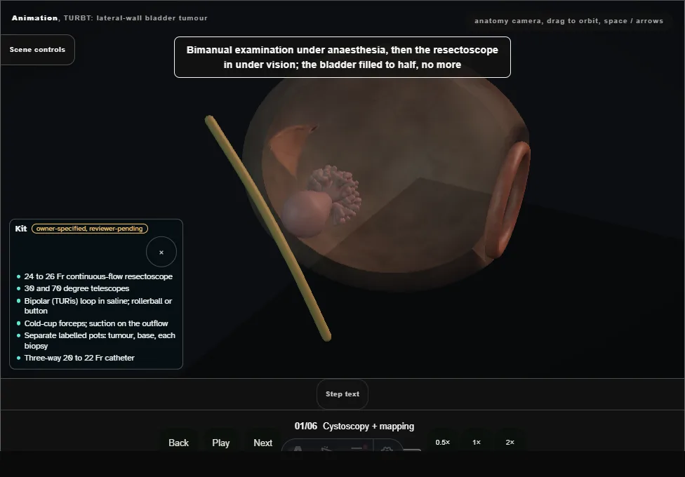 TURBT: lateral-wall bladder tumour. Step 1: Cystoscopy + mapping. Captured frame from the interactive animation.