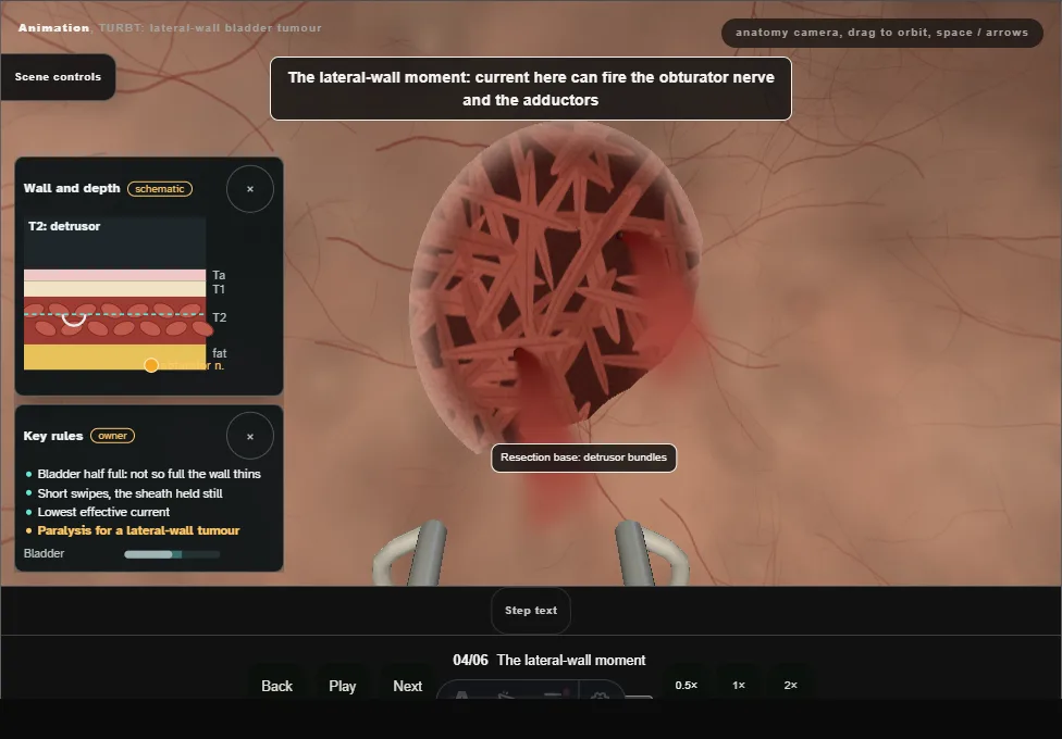 TURBT: lateral-wall bladder tumour. Step 4: The lateral-wall moment. Captured frame from the interactive animation.