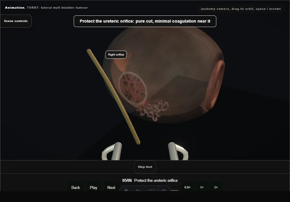 TURBT: lateral-wall bladder tumour. Step 5: Protect the ureteric orifice. Captured frame from the interactive animation.